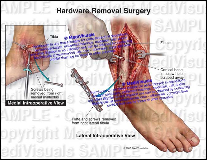 Normal Right Foot and Ankle Anatomy - #1237 - PI Exhibits NOW!