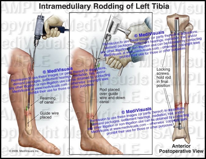 Intramedullary Rodding of Left Tibia - #1135 - PI Exhibits NOW!
